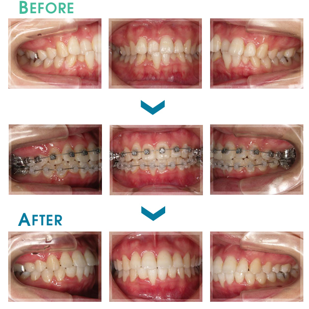 期間の短い矯正治療